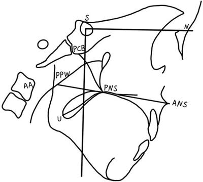Comparison of velopharyngeal morphology of two palatoplasty techniques in patients with hard and soft cleft palate